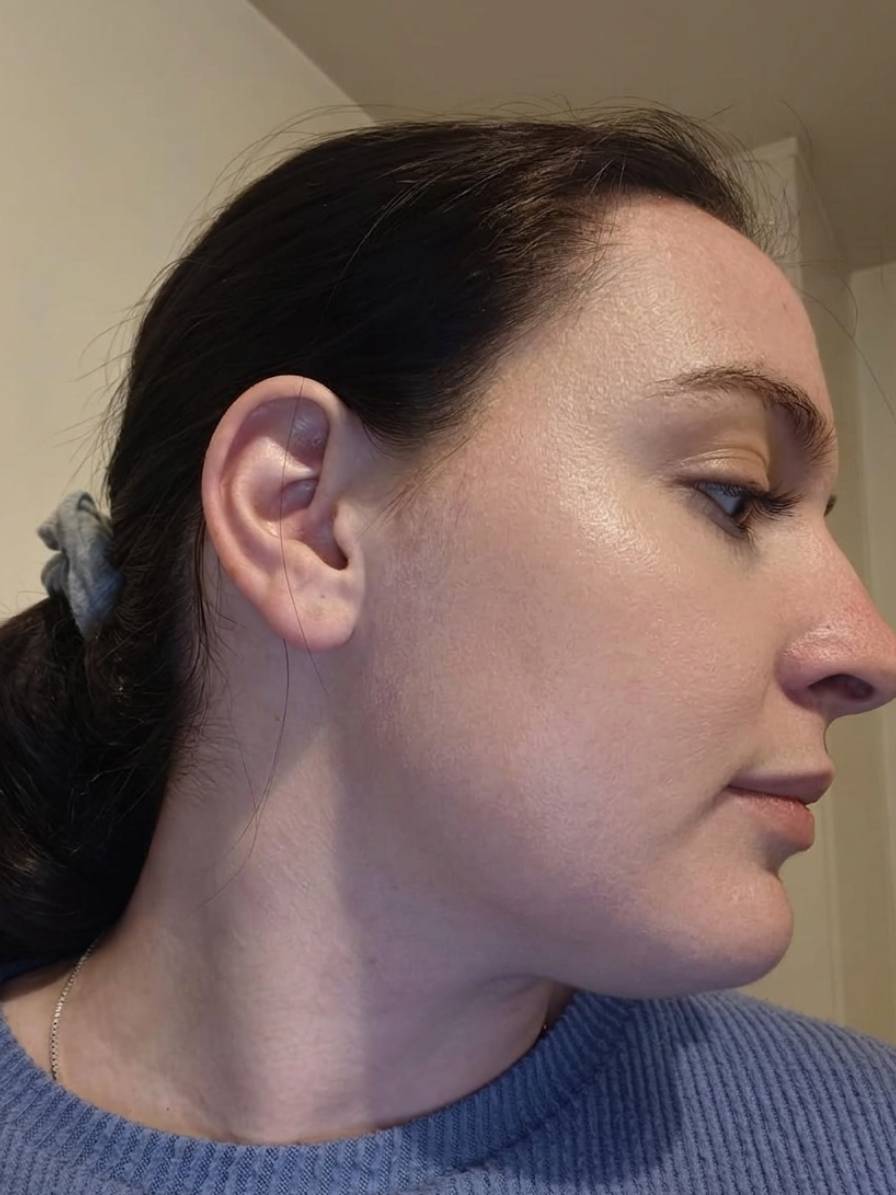 After Treatment